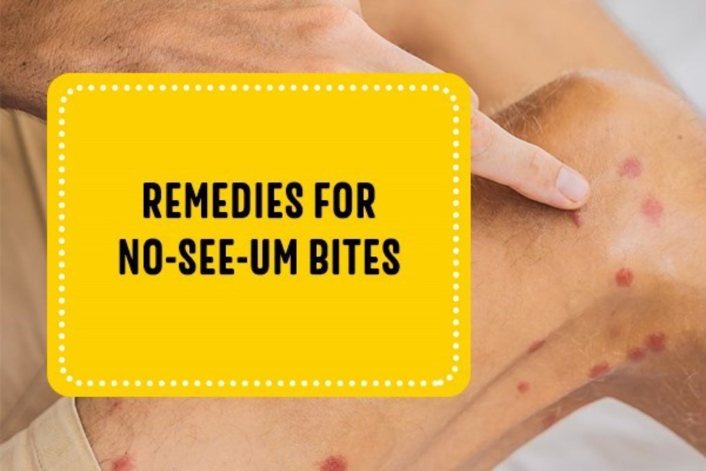 Remedies for No-See-Um Bites